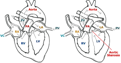 Heart affected by SAS